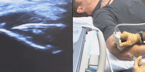 PRP Injection ultrasound and photograph of needle injecting patient's platlets into a tendon tear.