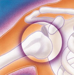 Diagram of glenohumeral (GH) dislocation – anterior dislocation
