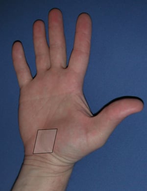 Photo showing carpal tunnel area where the median nerve is located.