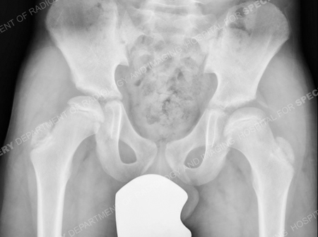 X-ray of child in the early stages of Perthes disease.