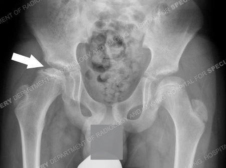 X-ray 8 months later showing femoral head collapse.