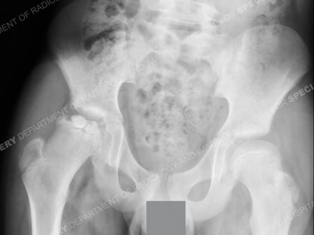 X-ray 10 months after the first showing irregular femoral head coming out of the hip socket