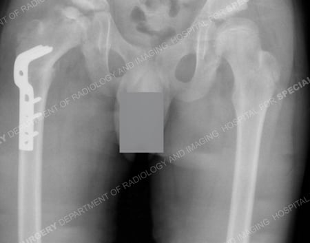 X-ray of femoral head after corrective surgery.