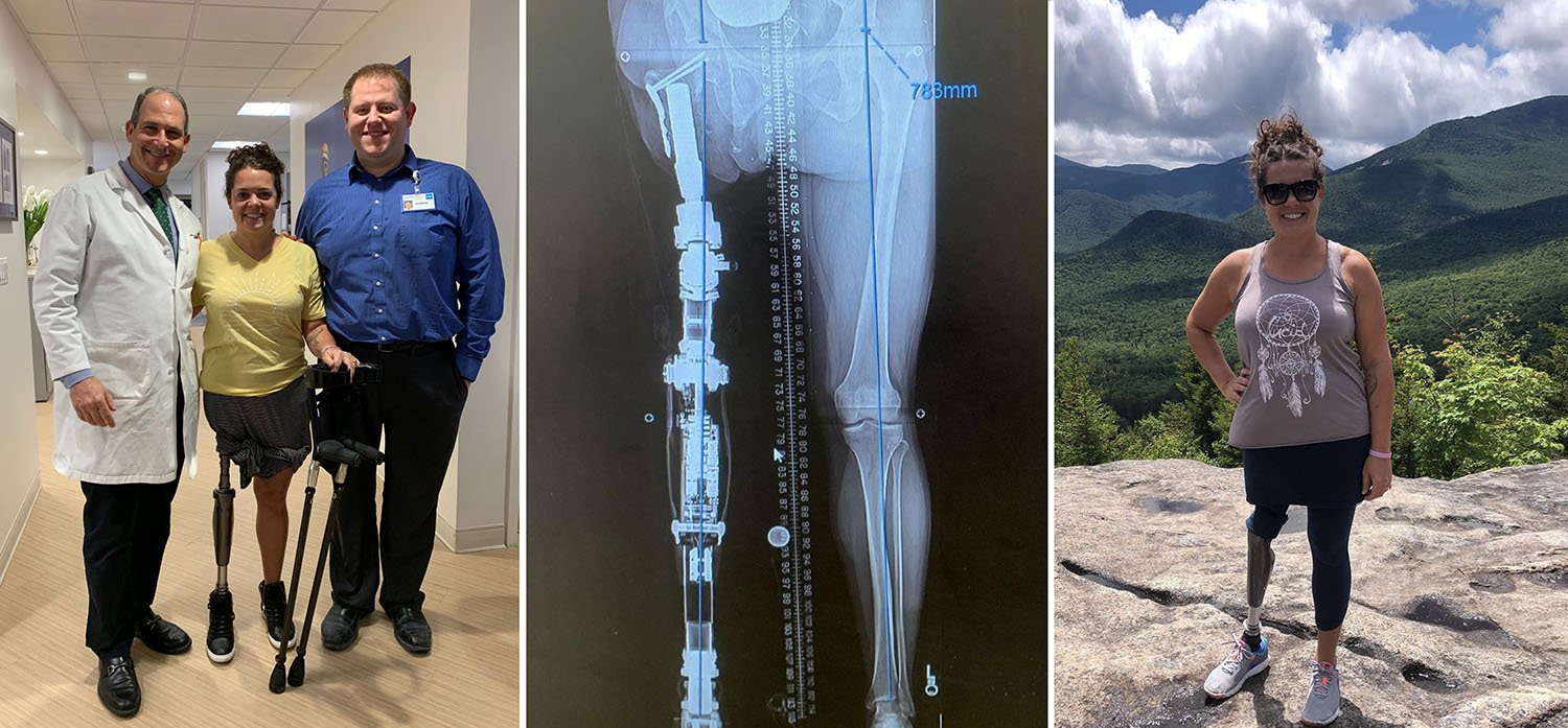 Patient Clayton demonstrating her osseointegrated limb