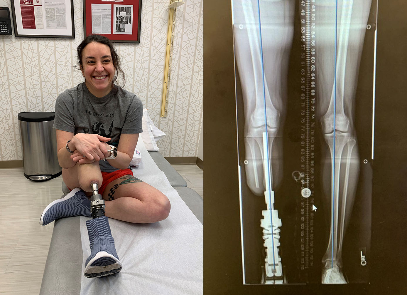 Patient Elena showing her osseointegrated limb prosthesis.