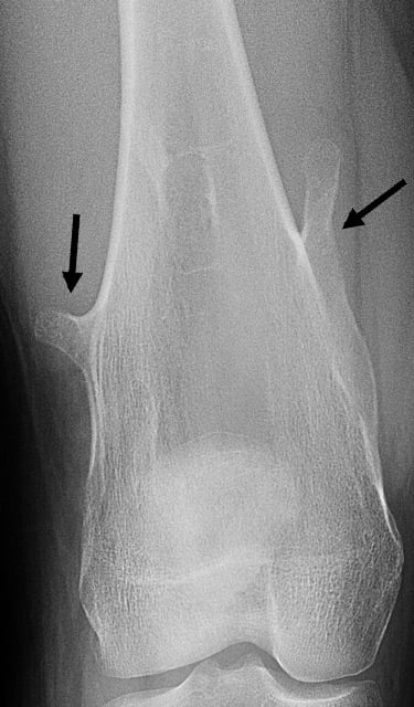 X-ray image of multiple, pedunculated osteochondroma bone tumors on a femur.