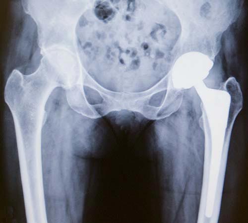 X-ray of a total hip replacement showing the ball, socket and stem implants.