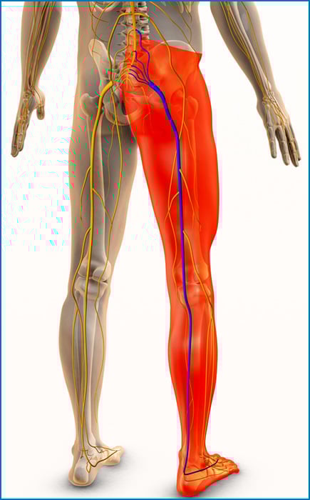 Illustration of the sciatic nerve and area of sciatica pain symptoms.
