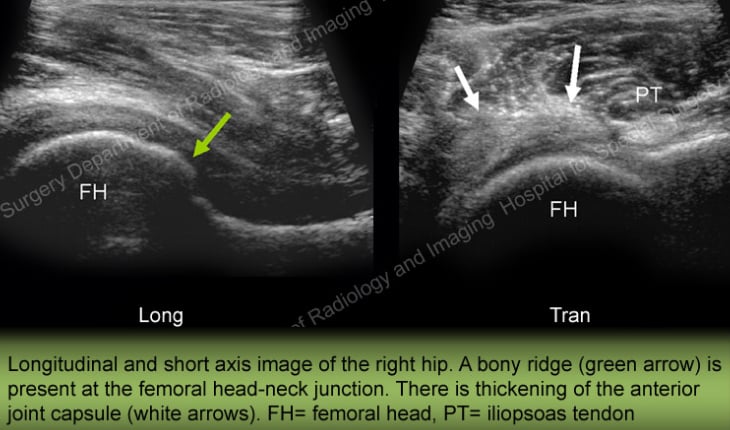 Image: Ultrasound of a right hip with osteoarthritis showing bony ridge and thickened joint capsule.