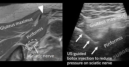 Ultrasound-guided botox injection of priformis muscle to alleviate sciatica.