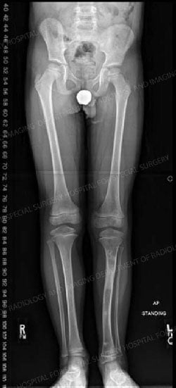X-ray im age postsurgery showing limbs of equal length.