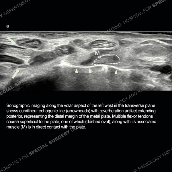 Sonographic imaging of the left wrist - Ultrasound Case 187