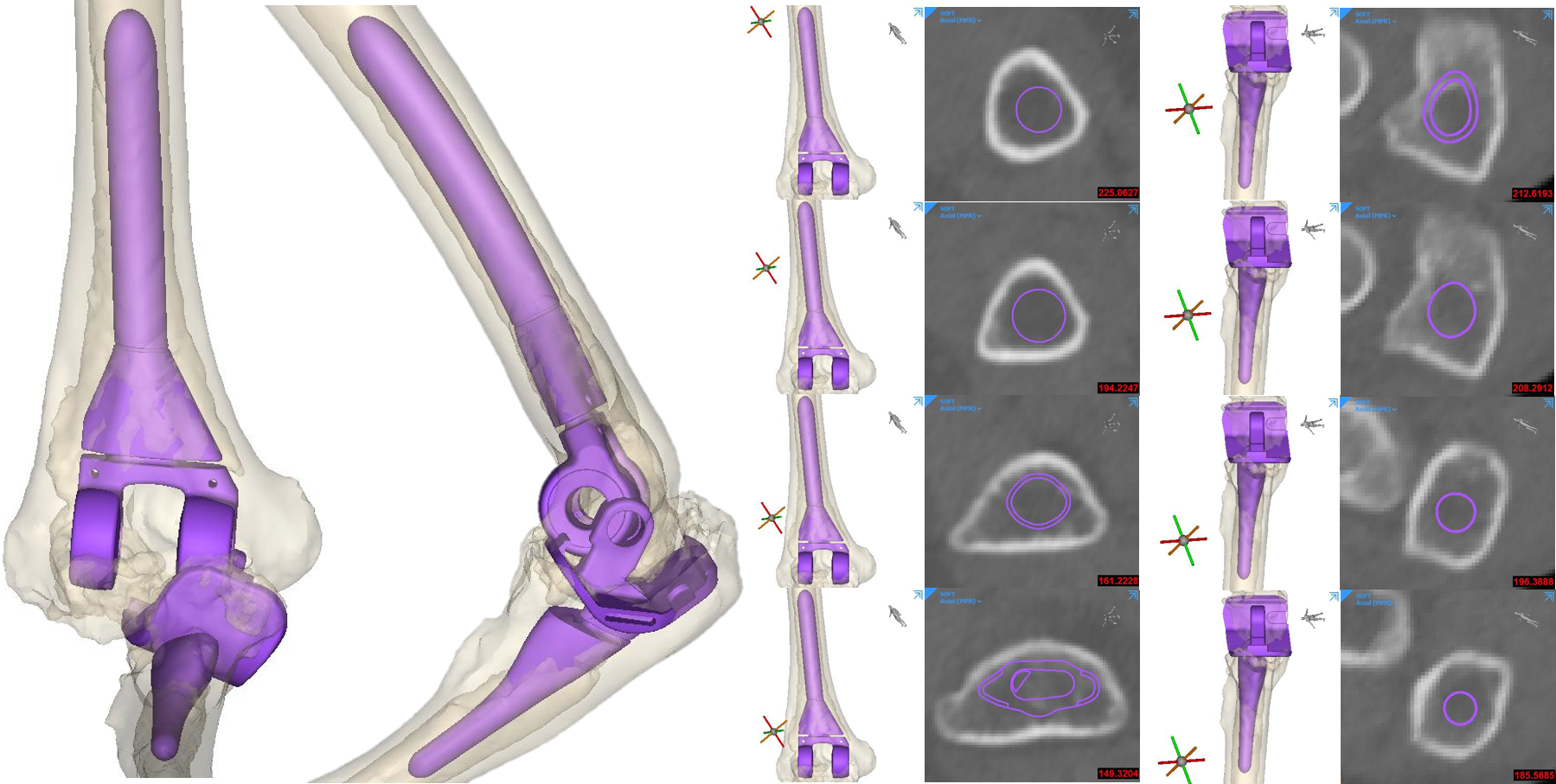Initial fit check of standard TEA component was done by the device development engineers. Both humeral and ulnar components were too small for a cementless TEA. Patient specific implants were needed.