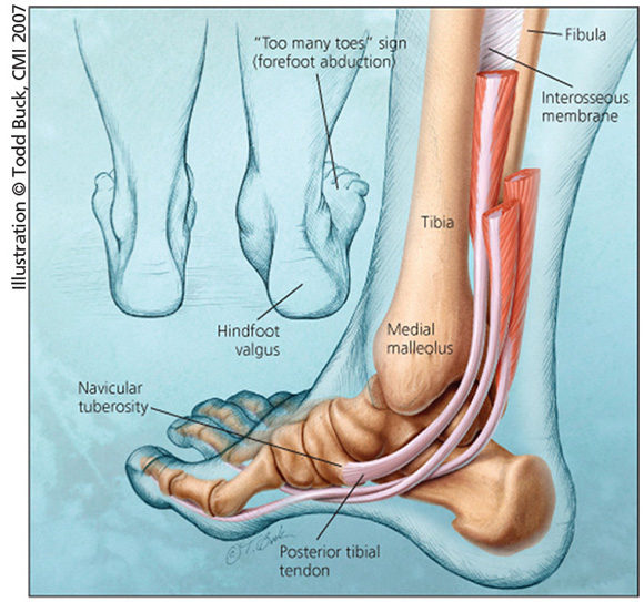 Tendons In The Ankle And Foot