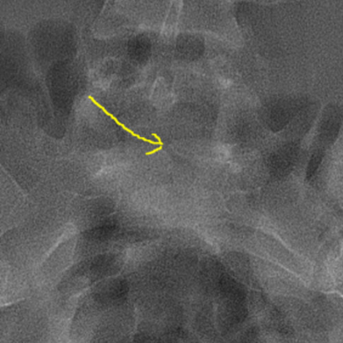 An X-ray showing a spina bifida defect.