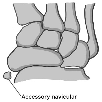 Illustration of accessory navicular location in the foot.