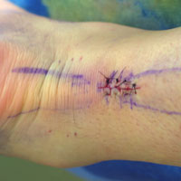 Photo of the patient's sutures post surgery