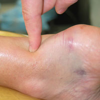 Close up photo of a finger pointing to the achilles tendon on a patient's foot