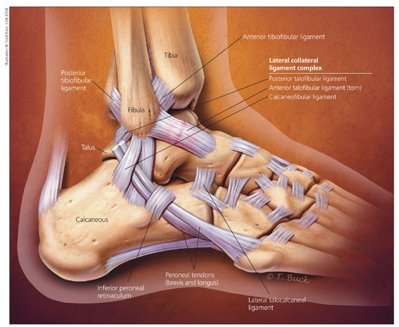 Common Ankle Injuries