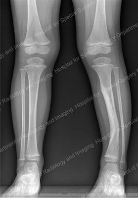 X-ray of an anterolateral bow in the tibia of a young patient