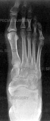 X-ray of a healthy foot