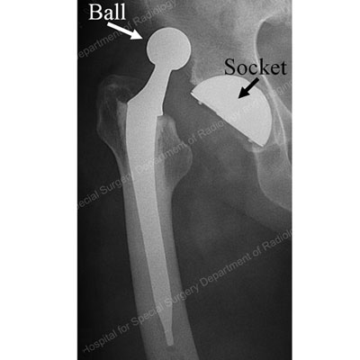 Prosthetic Hip Dislocation