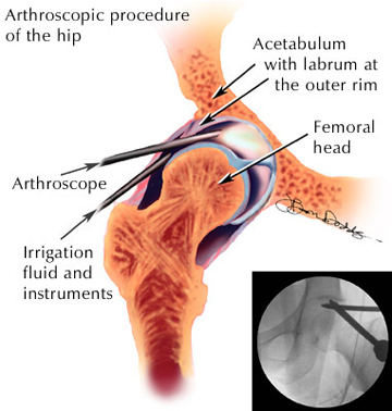 hip injection