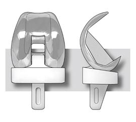 Illustration of the Insall-Burstein knee replacement prosthesis.