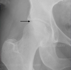 Anteroposterior radiograph of a normal hip joint