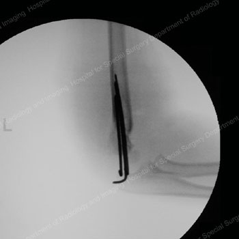 X-ray image showing supracondylar humerus fracture after treatment with realignment and wiring.