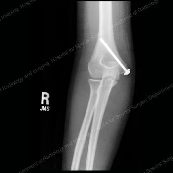 X-ray image showing anterior view of a medial epicondyle fracture with screw set in bone to secure bone fragment.