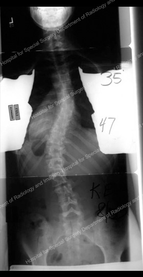 Front view resurgical X-ray for scoliosis requiring anterior approach. 