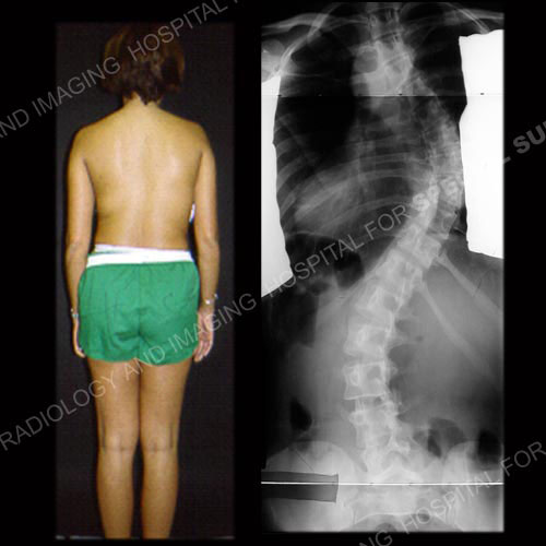 Pre-op images of an adult with thoracic scoliosis (photo and X-ray).