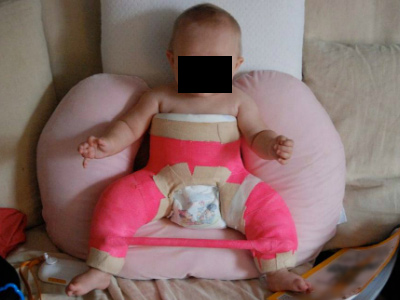 An infant wearing a spica cast to treat hip dysplasia.