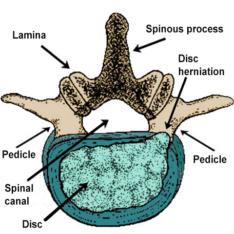 Illustration of a cross-section of a lumbar spinal vertebra showing a disc herniation.