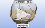 Graphic: Meniscal tear repair animation