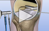 Graphic: Meniscal tear trimming animation