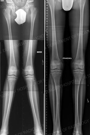 X-ray images of knock knees and then straightened legs after corrective osteotomy.