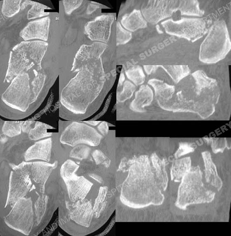 CT scan images further delineating the calcaneus fracture pattern from Orthopedic Trauma Service at Hospital for Special Surgery.