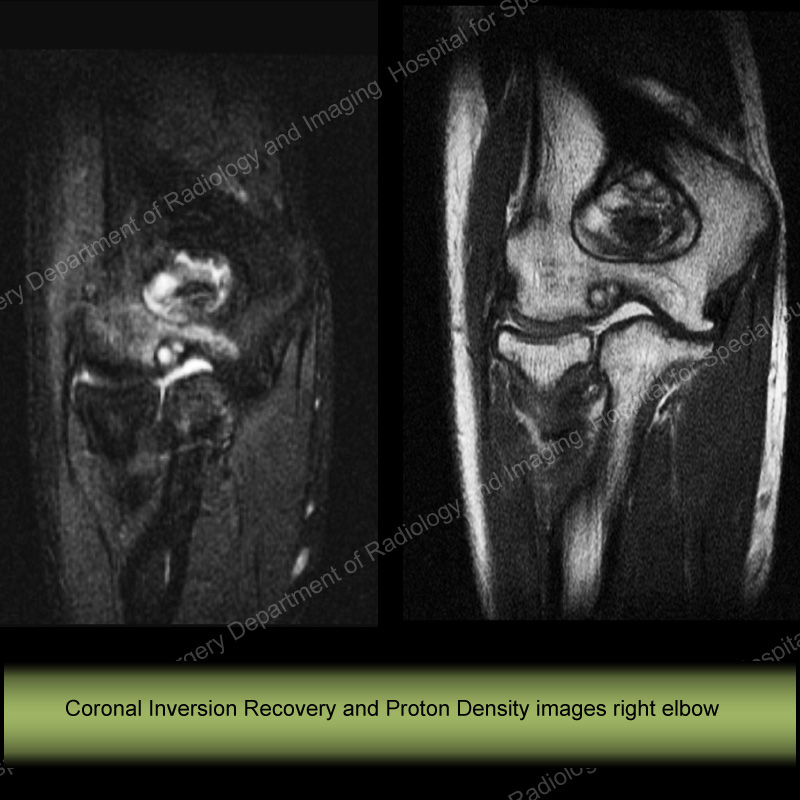 Coronal Inversion Recovery and Proton Density Images Right Elbow