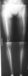 Rosa, follow up thumbnail of an x-ray, Limb Lengthening, limb realignment, equal leg lengths, painless, no limp