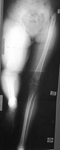Rosa, Pre-op thumbnail of an x-ray, Limb Lengthening, hip infection, severe limp, completel hip destruction