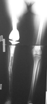 Colleen, Follow up thumbnail of an x-ray, Limb Lengthening, knee replacement, leg length discrepancy corrected, removal of irradiated bone