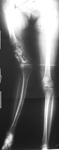 Colleen, Pre-Op thumbnail of an x-ray, Limb Lengthening, bone tumor, damaged to growth plate, valgus deformity, equinovarus deformity, foot deformity