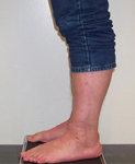 Richard, Follow up thumbnail image, Limb Lengthening, ankle fusion, ankle arthrodesis, mobility, pain relief