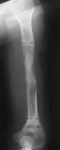 Donald, Follow up thumbnail of an x-ray, Limb Lengthening, lengthened humerus, arm lengthening