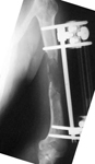 Donald, Post-Op thumbnail of an x-ray, Limb Lengthening, osteotomy, humerus, EBI frame, Ilizarov method