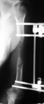 Donald, Post-Op thumbnail of an x-ray, Limb Lengthening, osteotomy, humerus, EBI frame, Ilizarov method