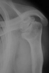 Donald, Pre-Op thumbnail of an x-ray, Limb Lengthening, damaged growth plate, stunted upper arm growth, short arm