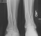 Juan, Pre-op thumbnail of an X-ray, Limb Lengthening, Distal Tibia fracture, compartment syndrome